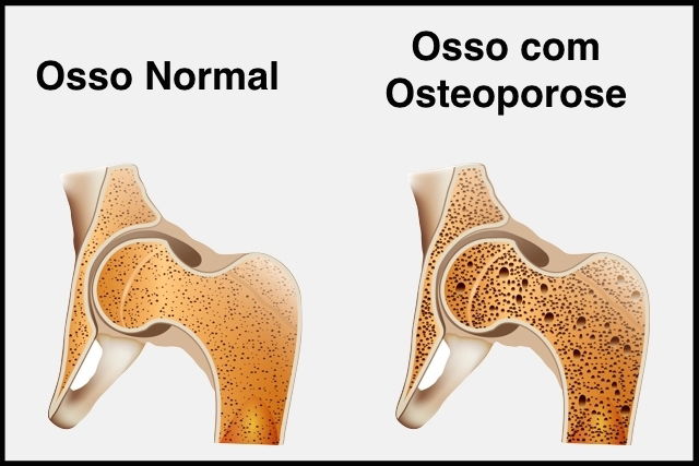 Remédios indicados para osteoporose Tua Saúde