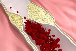 Imagen ilustrativa del artículo Enfermedad arterial coronaria: qué es, síntomas y tratamiento
