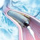 Angioplastia: o que é, quando é indicada e como é feita