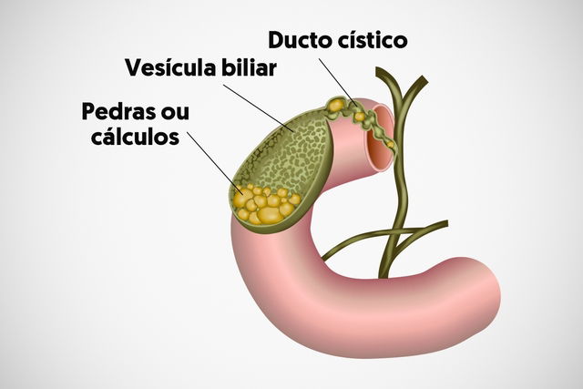 Colecistite aguda e crônica: o que são, sintomas e tratamento