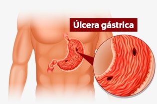 Imagen ilustrativa del artículo 7 síntomas de úlcera estomacal (y quién tiene más riesgo)