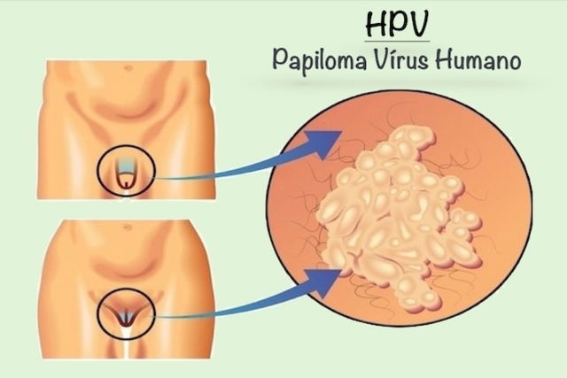 humán papilloma vírus nas l bulas r