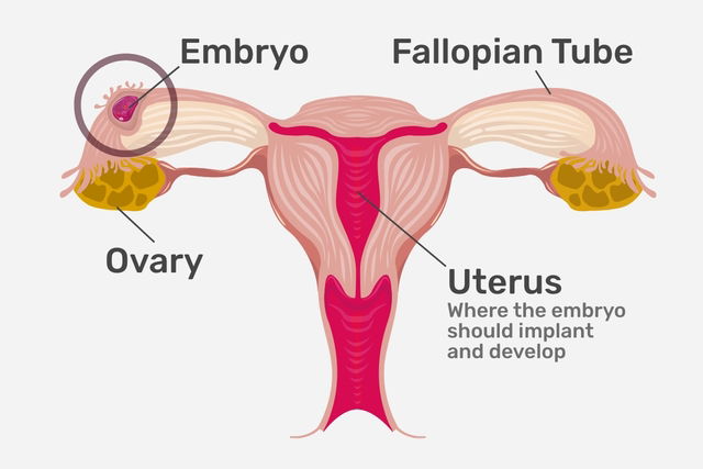 Does Ectopic Pregnancy Cause Stomach Bloating