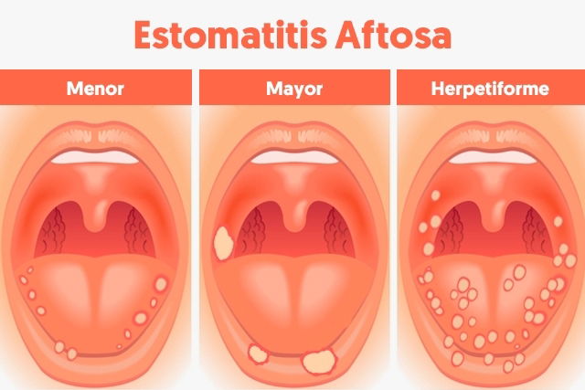 Síntomas y tratamiento de la Estomatitis Aftosa Tua Saúde