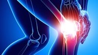 Líquido en la rodilla: síntomas y tratamiento