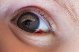 Mancha vermelha no olho: 6 causas comuns (e o que fazer)