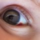 Mancha roja en el ojo: 6 causas y qué hacer