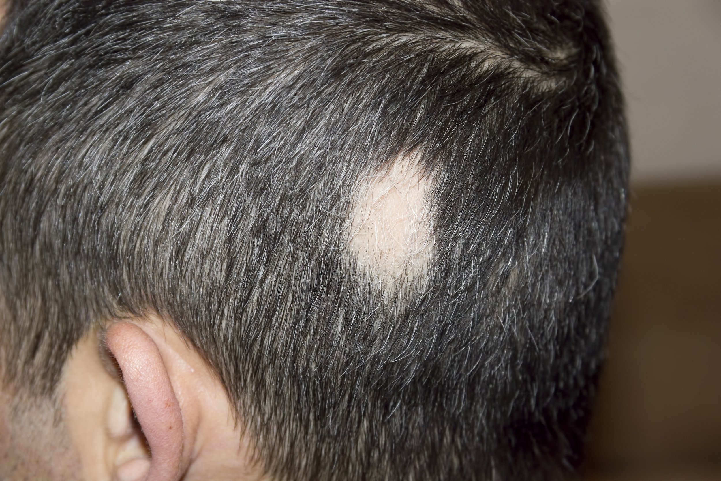Alopecia Areata: Symptoms, Causes & Treatment - Tua Saúde