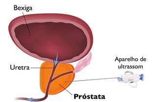Prostatite sangue
