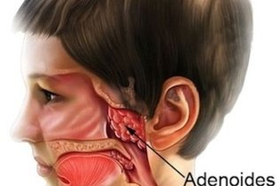 Adenoides inflamadas: qué es, síntomas y tratamiento