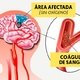 Trombosis cerebral: qué es, síntomas, secuelas y tratamiento