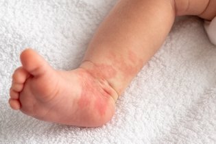 Imagem ilustrativa do artigo Hemangioma infantil: o que é, sintomas, causas e tratamento