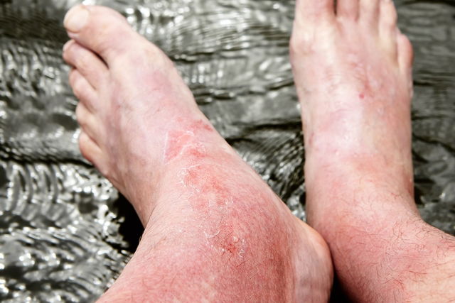 Why Are My Feet Peeling? Top 5 Causes - Tua Saúde