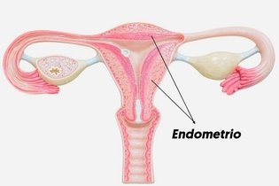 Imagen ilustrativa del artículo Hiperplasia endometrial: qué es, síntomas y tratamiento