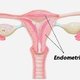 Hiperplasia endometrial: qué es, síntomas y tratamiento