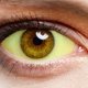 Ojos amarillos: 9 causas y qué hacer