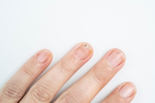 Como quitar el amarillo de las uñas por esmalte?