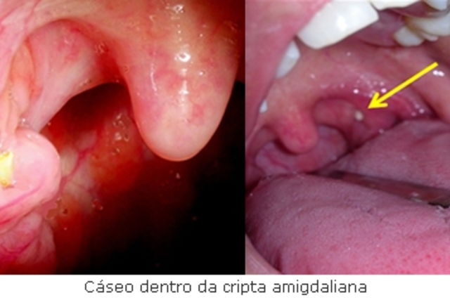 Cáseos amigdaliano (caseum): o que é, sintomas, causas e