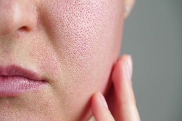 Piel seca con acné: tratarla y productos usar - Tua Saúde