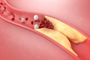 Imagen ilustrativa del artículo Colesterol alto: síntomas, causas y cómo bajarlo