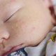 Acné neonatal: causas y tratamiento