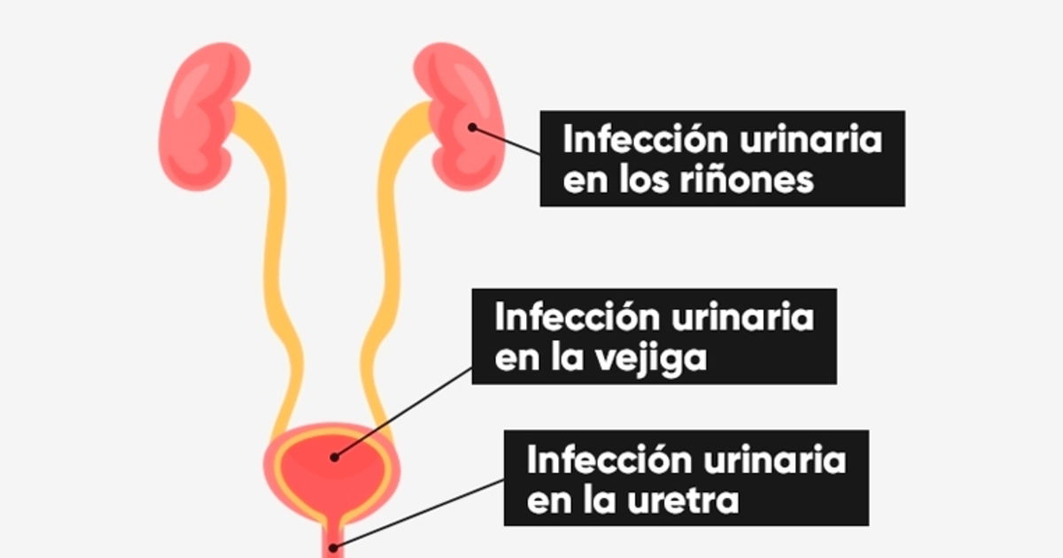 La Infección Urinaria Puede Llegar Hasta Los Riñones Tua Saúde 3388