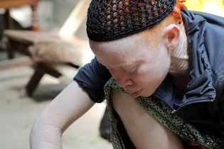 Imagem ilustrativa do artigo Albinismo: o que é, características, causas e cuidados