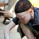Albinismo: o que é, características, causas e cuidados