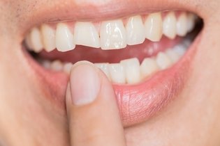 Imagem ilustrativa do artigo Dente quebrado: sintomas, causas e o que fazer