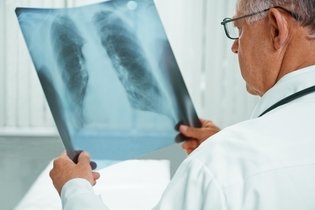 Imagem ilustrativa do artigo O que significa decorticação pulmonar?