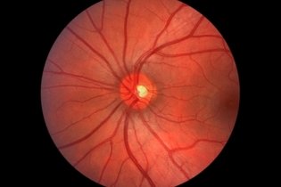 Imagem ilustrativa do artigo O que é retinopatia hipertensiva e quais os sintomas