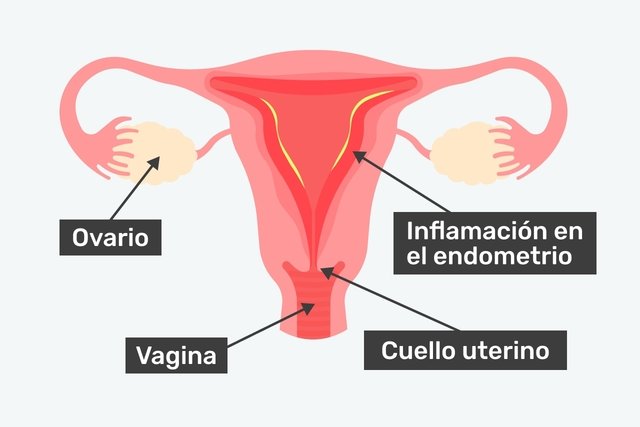 Útero con endometritis