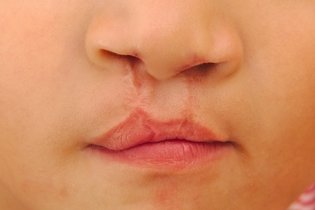 Imagem ilustrativa do artigo Cirurgia para lábio leporino e fenda palatina: como é feita e recuperação