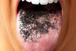 Illustrative image of the article Black Tongue: Causes, Symptoms & Treatment