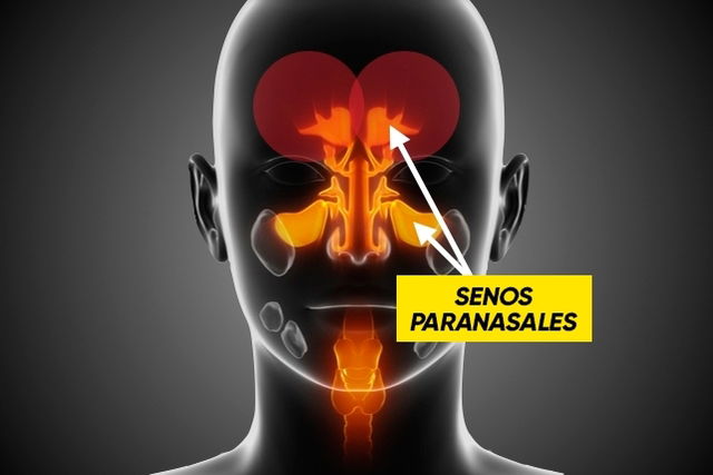 Sinusitis Y Dolor De Cabeza