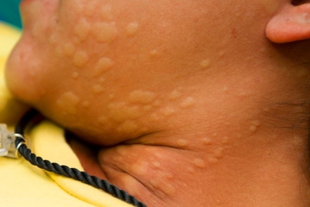Illustrative image of the article Hives (Urticaria): Causes, Symptoms & How to Get Rid of Them