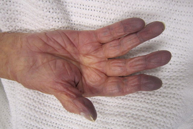 Foto de mão com acrocianose
