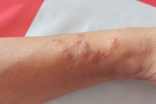 Imagen ilustrativa del artículo Cómo saber si tengo parásitos bajo la piel (Larva migrans)