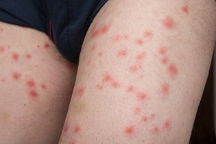 Imagen ilustrativa del artículo Picadura de pulgas: síntomas y cómo curar