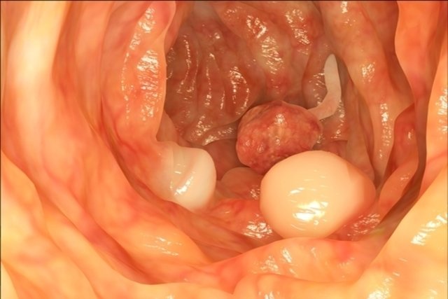 Pólipos en el colon