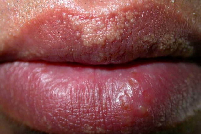 white spots inside lips