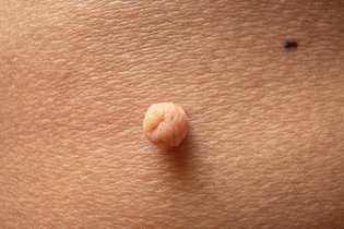 Imagem ilustrativa do artigo Fibroma mole (acrocórdon): o que é, causas e tratamento