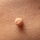 Fibroma mole (acrocórdon): o que é, causas e tratamento