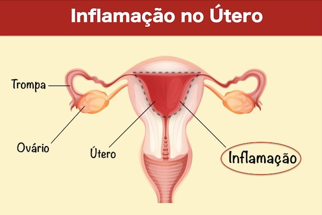 7 sintomas de inflamação no ovário, causas e tratamento - Tua Saúde