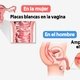 Síntomas de candidiasis genital, oral, en la piel e intestinal