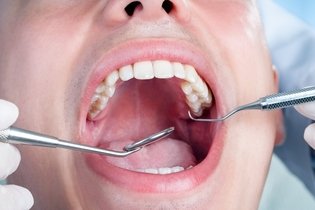 Bump on the Roof of the Mouth: 8 Causes & What to Do