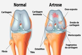 Imagem ilustrativa do artigo Artrose tem cura? O que fazer para tratar