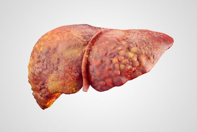 Hígado con cirrosis hepática
