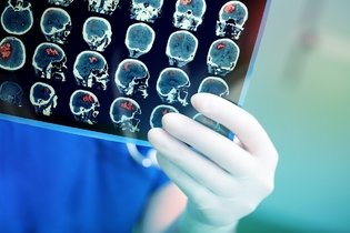 Concussão cerebral: o que é, sintomas, causas e sequelas