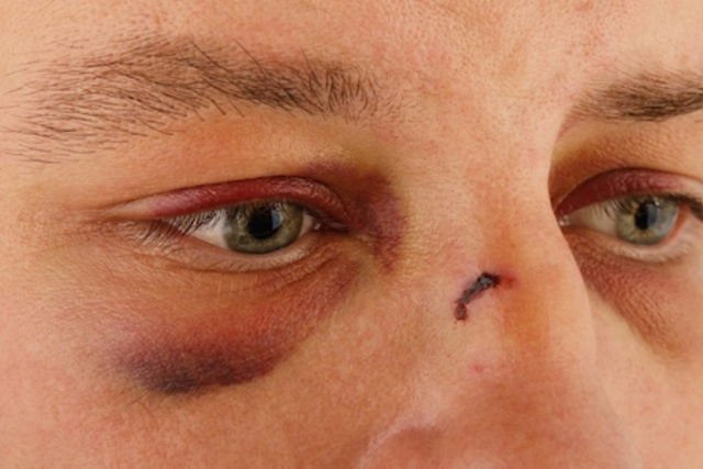 O Que Tira Hematoma Roxo Do Olho Sobre Os Olhos